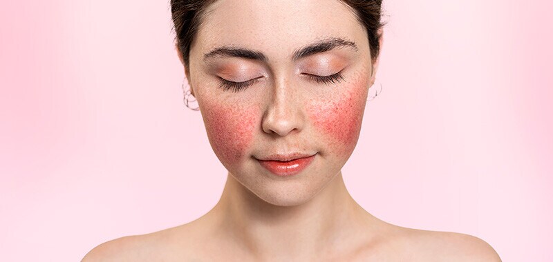 Fullsize mobile rosacea Fullsize mobile rosacea