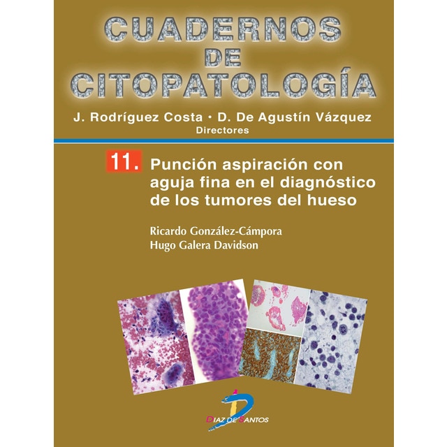 Imagen 0 de Punción aspiración con aguja fina en el diagnóstico de los tumores de hueso: Cuadernos de citopatologia-11