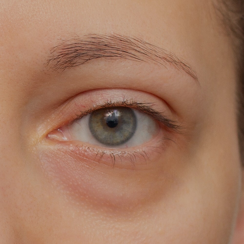 Bolsas y ojeras
