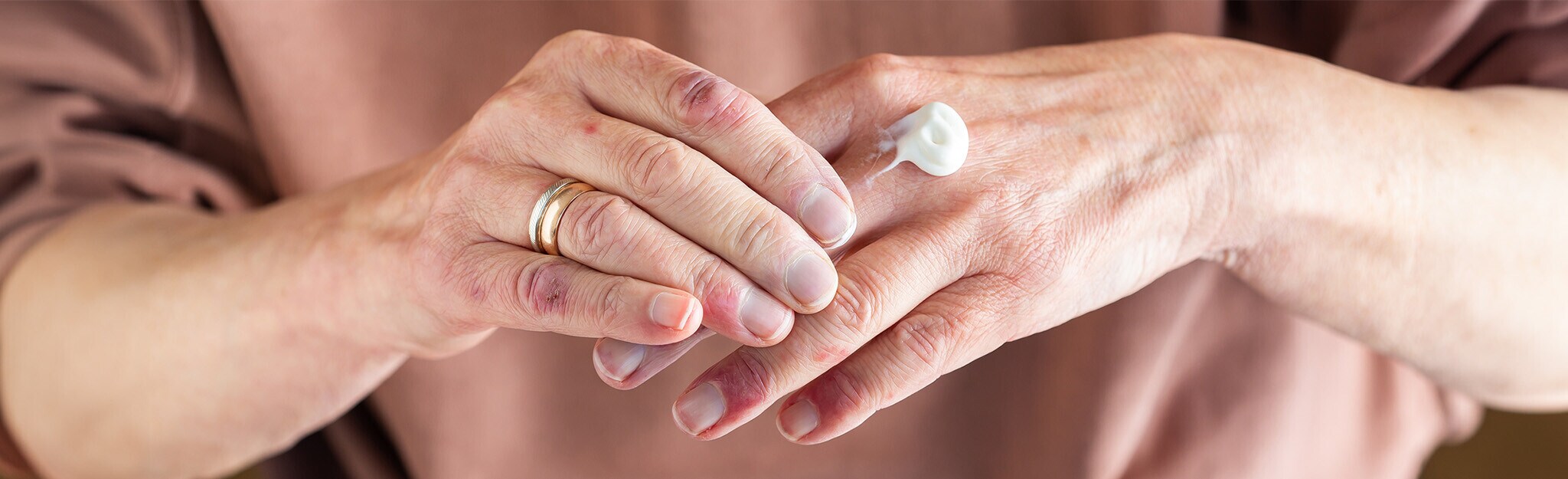 Editorial |  Como tratar a Psoríase