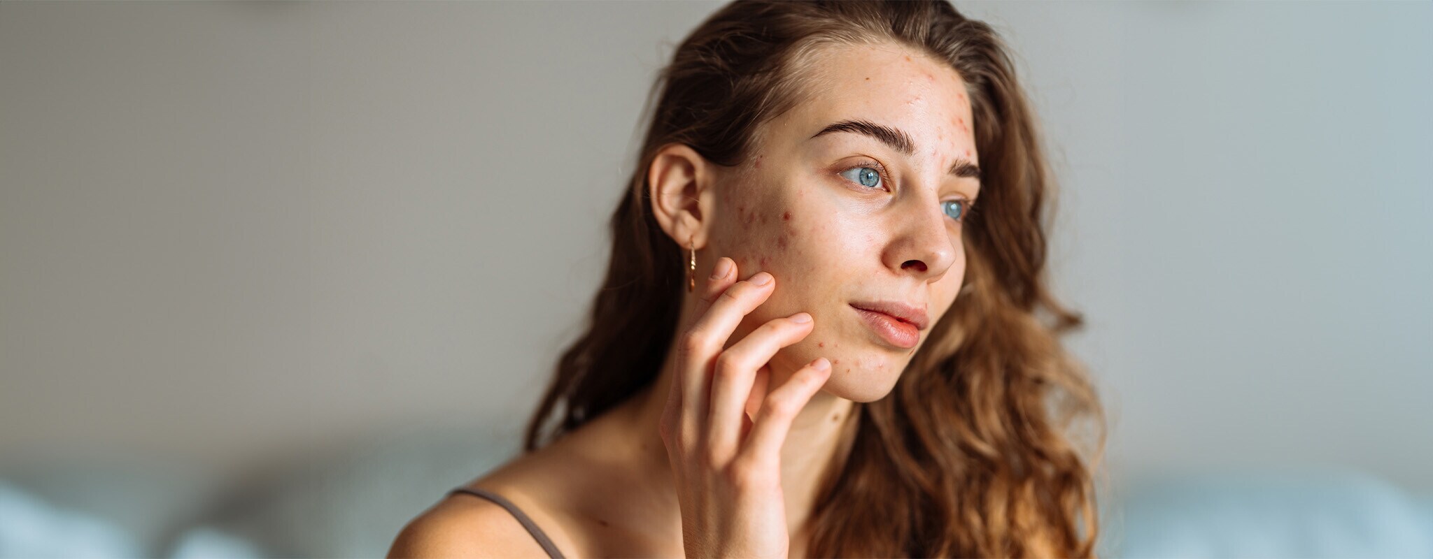 Acne na idade adulta