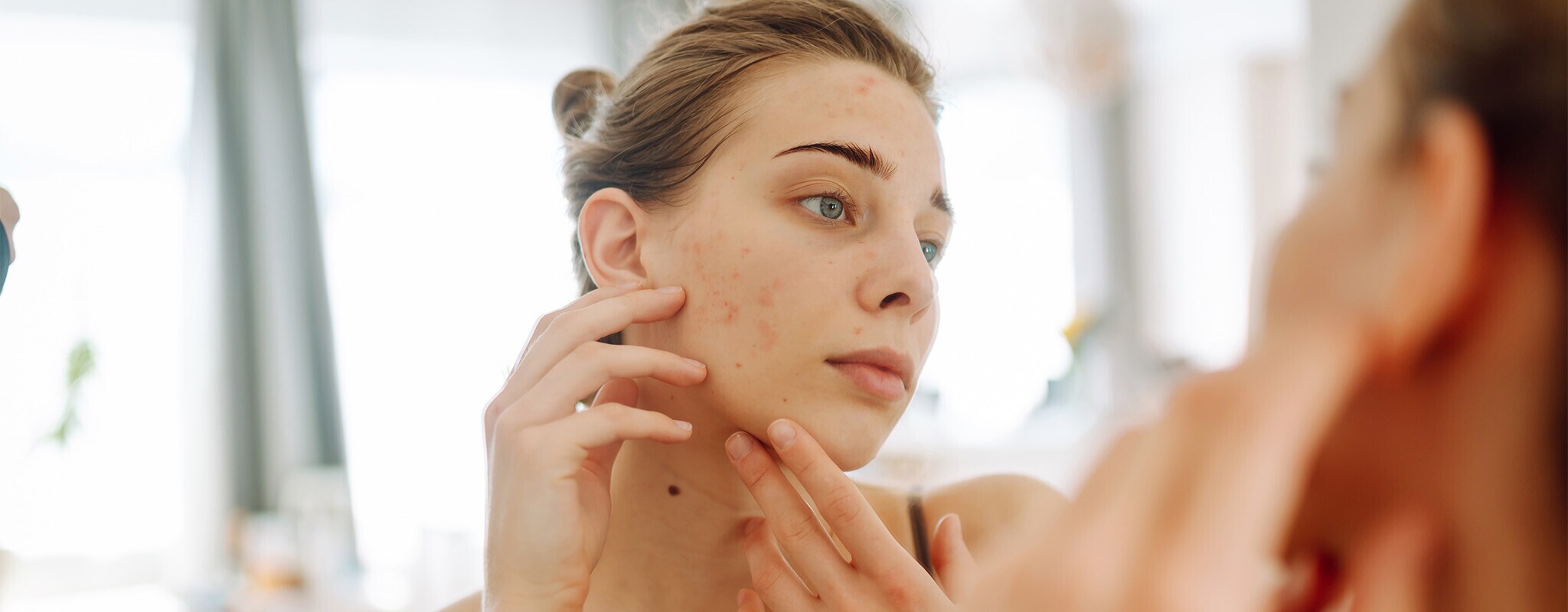 Acne na idade adulta