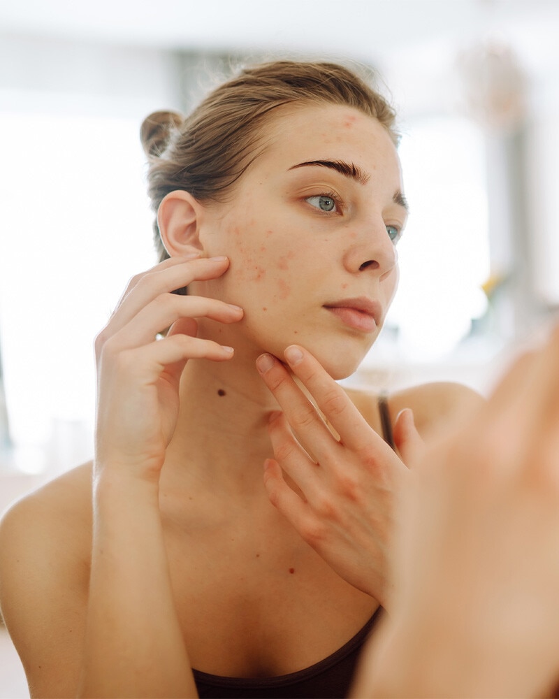 Acne na idade adulta